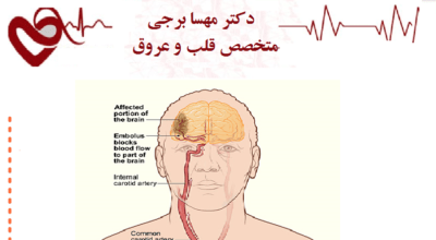 آیا آریتمی قلبی باعث سکته مغزی می شود؟